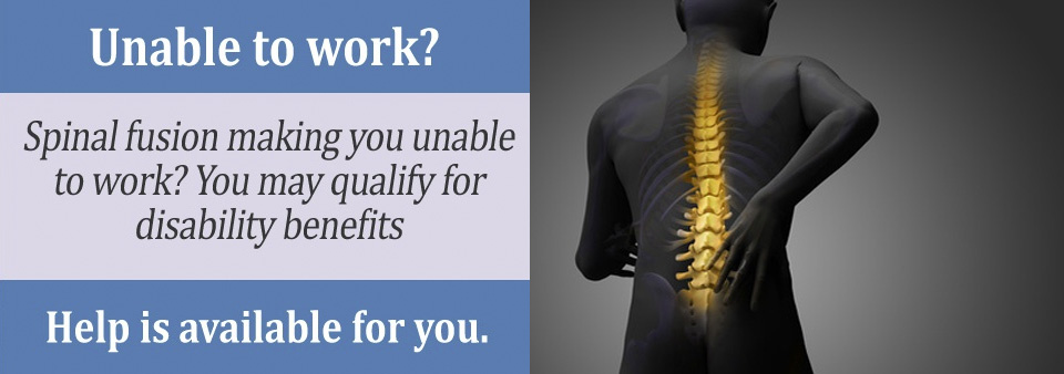 Your Spinal Fusion may qualify you for Social Security disability benefits.