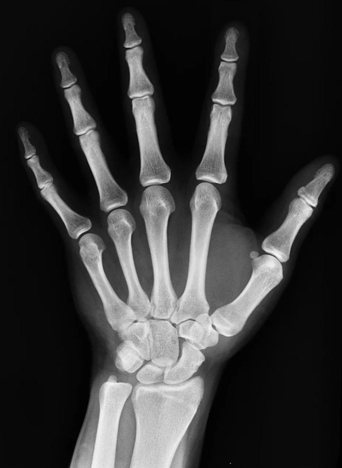 Qualify for Social Security disability with Arthritis