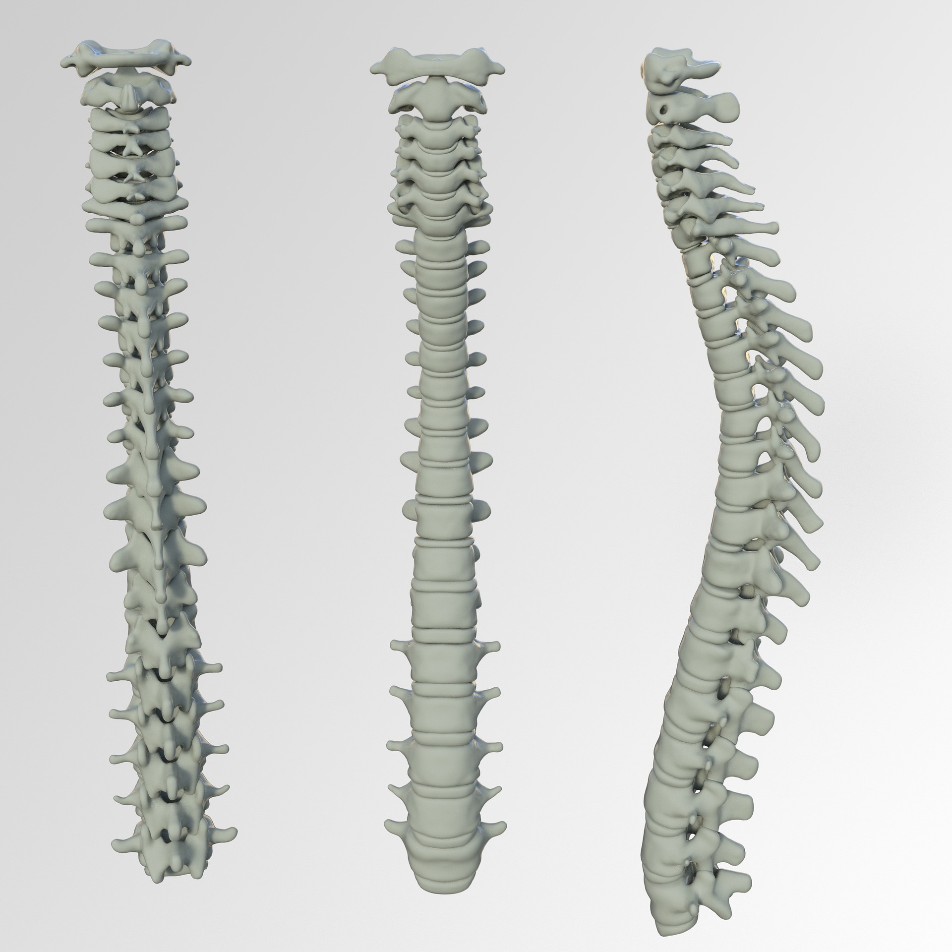 spine-curve-comparison-scoliosis-dbh